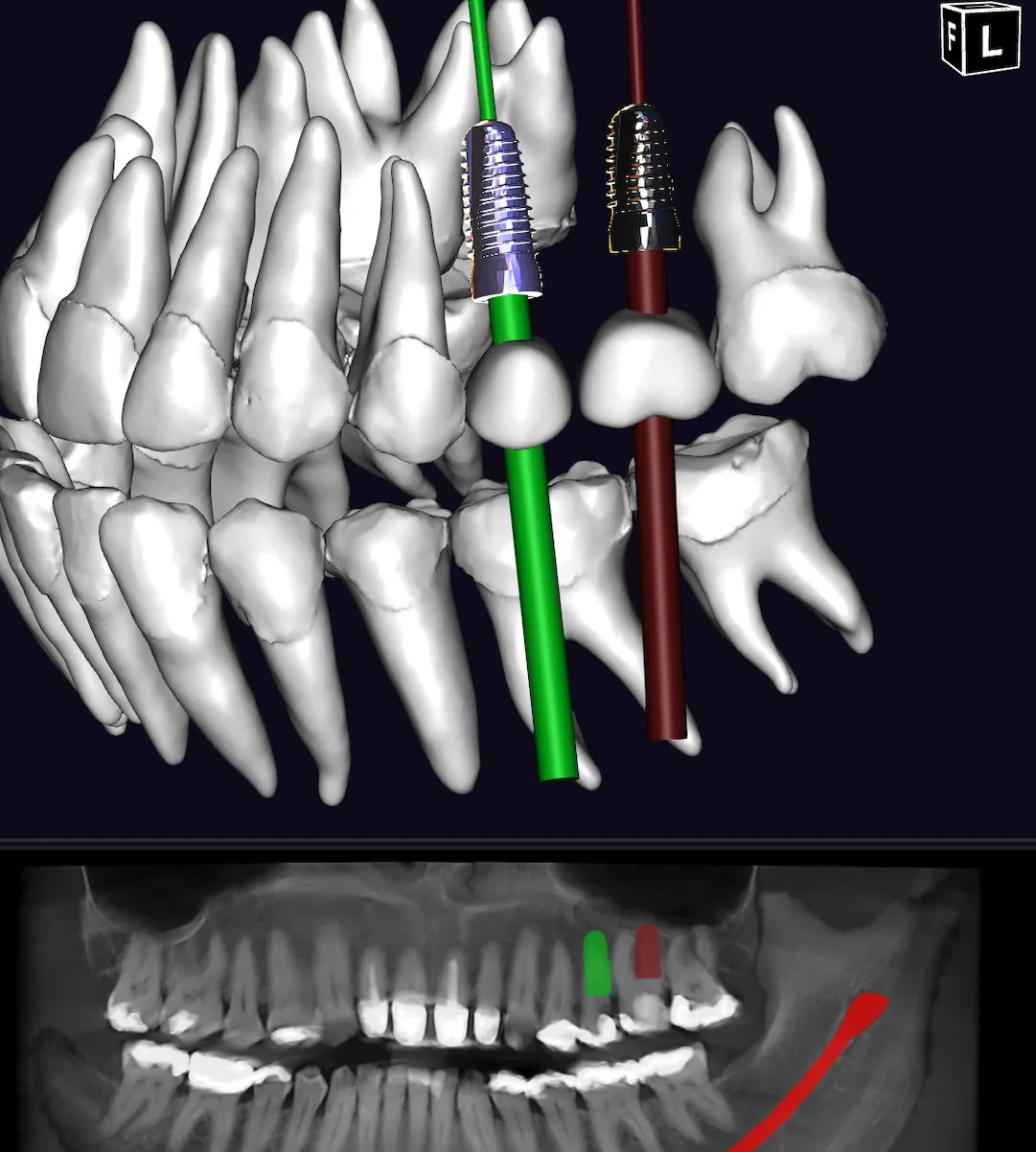 Digitale Implantatplanung