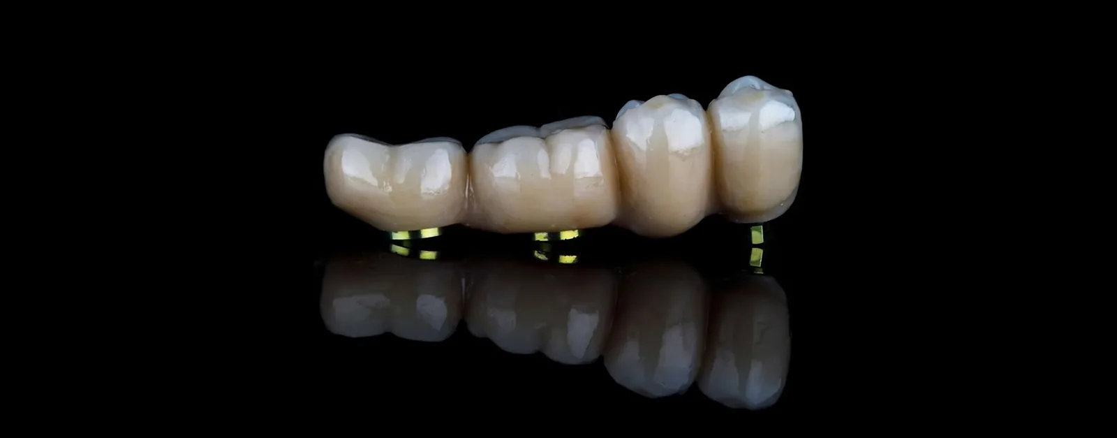 Zahnersatz auf Implantaten